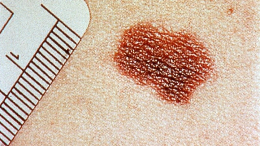 El melanoma es un cáncer de piel.