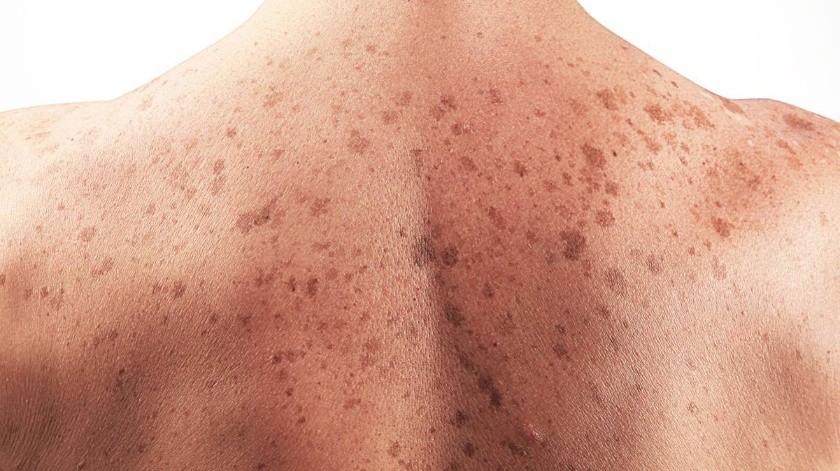 El melanoma no siempre esta asociado con los rayos UV(Tomada de la red)