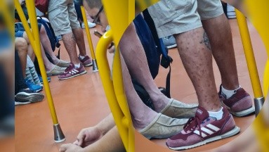 Infectado con viruela del mono en metro de España; médico lo cuestiona por no estar en aislamiento