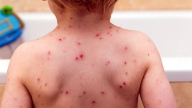 Aumentan casos de varicela en México: expertos revelan posibles causas
