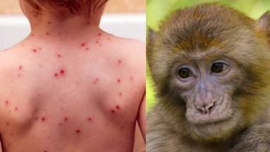 Aíslan a dos menores por posible contagio de viruela del mono en Sinaloa