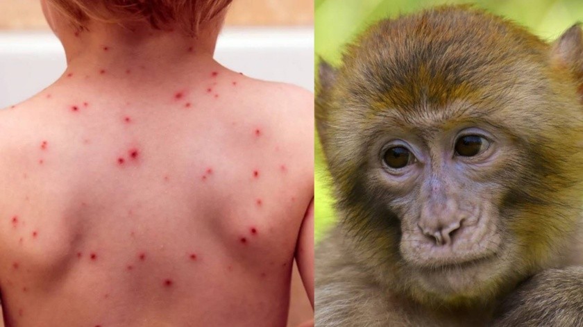Aíslan a dos menores por posible contagio de viruela del mono en Sinaloa(Especial y Pixabay)