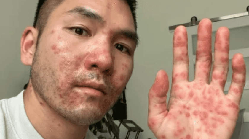 Hombre es diagnosticado con herpes y sarna pero tenía el virus de la viruela del mono(Kevin Kwong)