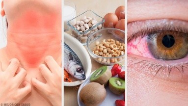 Una alergia alimentaria podría brindarte protección contra el virus del Covid-19