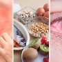 Una alergia alimentaria podría brindarte protección contra el virus del Covid-19