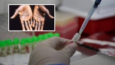 México registra 2 mil 654 casos de viruela del mono; aumentaron 186 la última semana