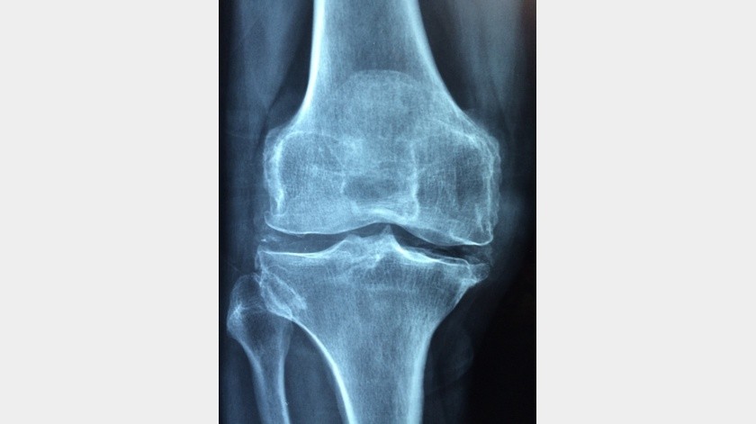 La artritis puede traer problemas de movimiento si no se atiende con un médico.(Pexels.)