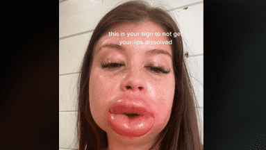 Joven se inyecta ácido hialurónico en los labios y termina con el rostro desfigurado