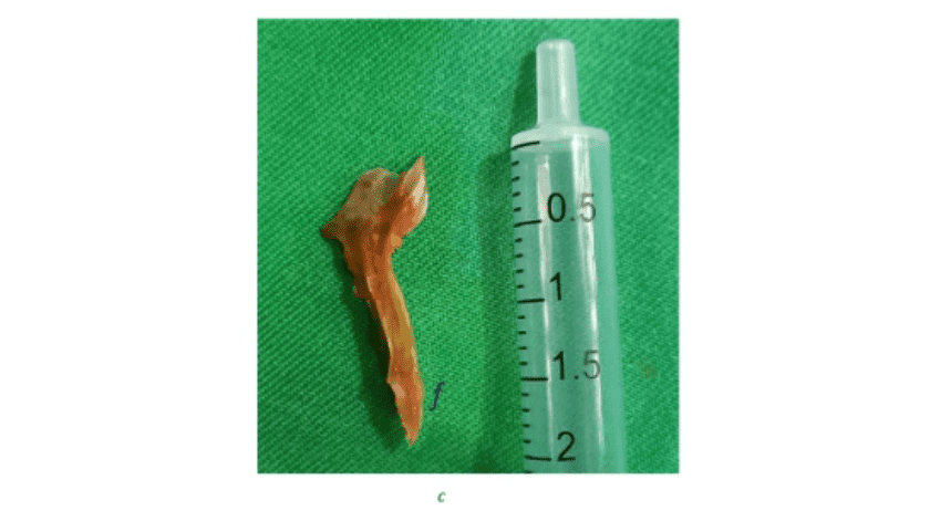 Los médicos encontraron una espina de pescado en su intestino. Foto:  International Journal of Surgery Case Reports