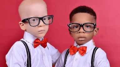 Hermanos mellizos con distinto color de piel; una condición genética provocaría su diferencia de tez
