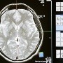 Alzheimer en México: Diagnóstico puede tardar al menos 12 meses según experto
