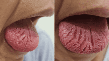 Revista científica revela mujer con lesiones dolorosas en la lengua; no pudo comer por meses
