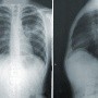 Cáncer de pulmón: Atención tardía eleva muertes y costos en Latinoamérica