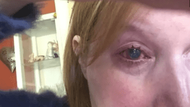 Mujer pierde el ojo tras contraer una infección al bañarse con sus lentes de contacto