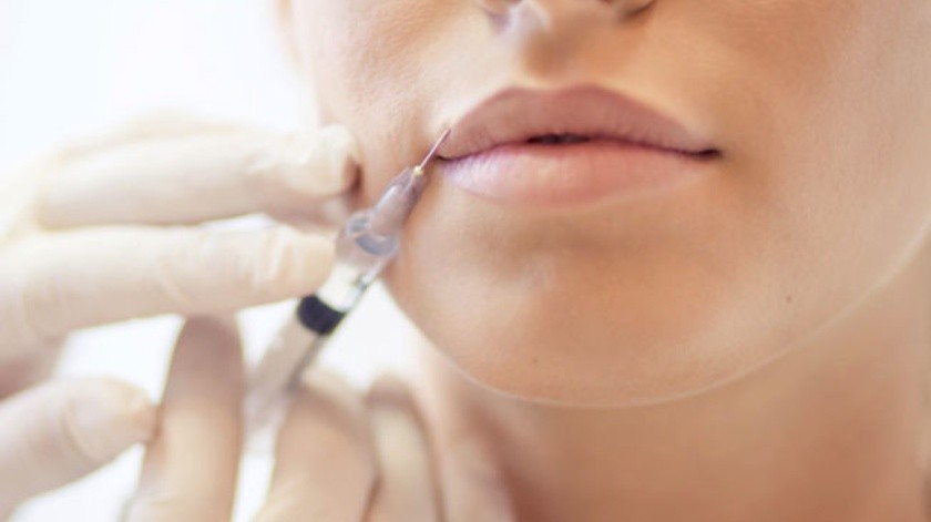 Si está pensando en hacerse relleno de labios hay que revisar con un doctor un historial(Cleveland Clinic.)