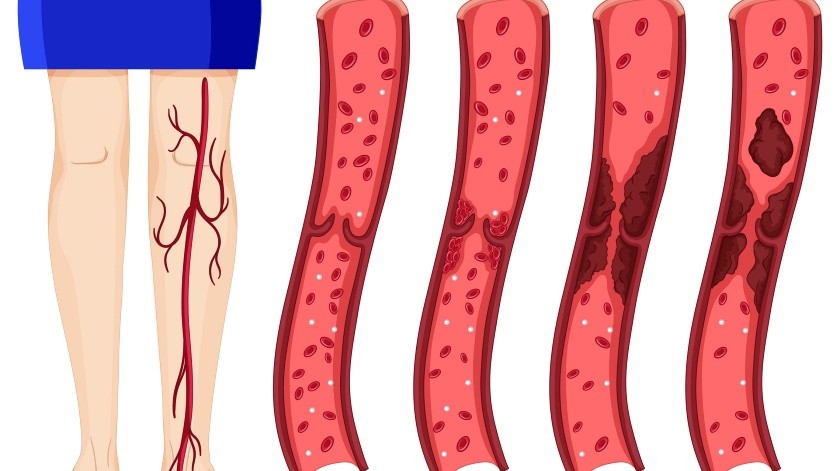 Por lo general los coágulos se forman en las piernas.(Freepik)