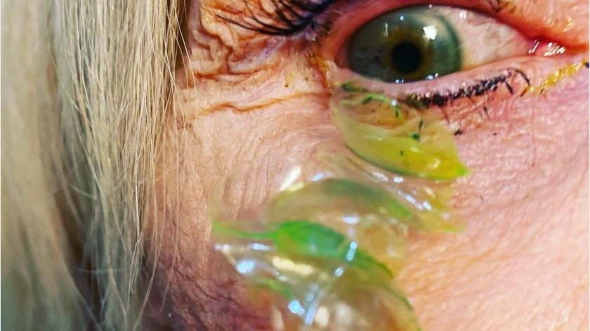 La mujer tenía 23 lentes de contacto en sus ojos.(Instagram)