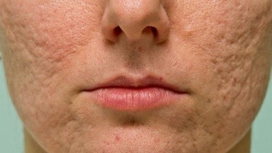 Cicatrices del acné: Cómo se pueden disminuir