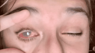 Joven de 13 años queda ciega de un ojo tras explotarle tinte para cabello en el rostro