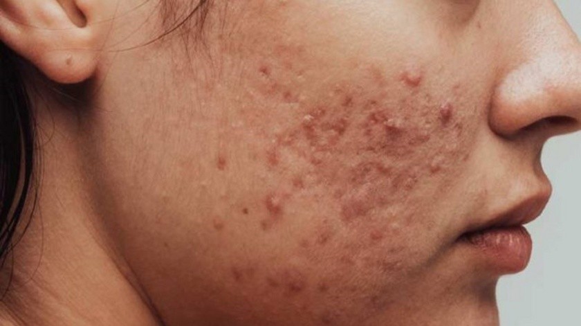 El acné a veces se puede prevenir.(Cleveland Clinic.)
