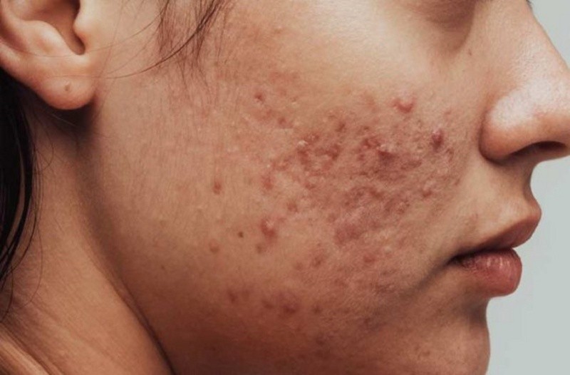 El acné a veces puede ser severo cuando hay problemas hormonales. Archivo GH. 