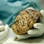 Alzheimer:  Identifican dos nuevos genes que aumentan el riesgo de desarrollarlo