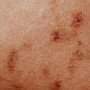 Cáncer de piel: ¿Cuáles son los signos para sospechar de la enfermedad?