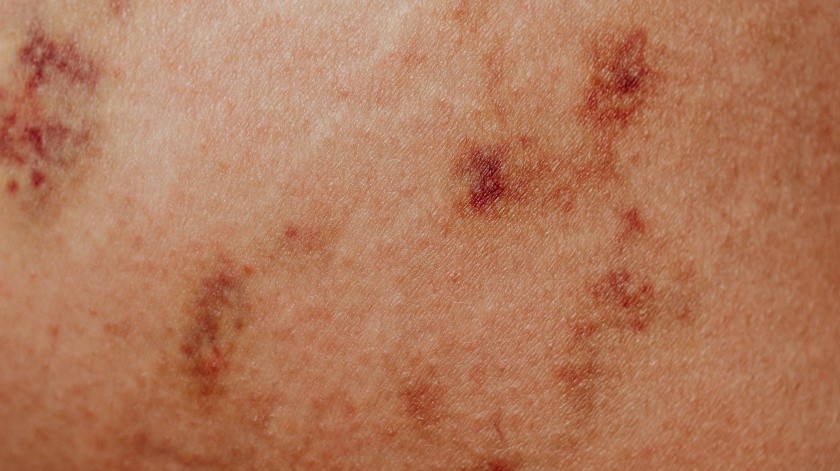 Un cambio en la piel es el signo más común de cáncer de piel.(PEXELS)