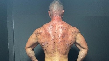 Fisicoculturista cuenta que usar esteroides le dejó cicatrices de acné y forúnculos