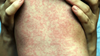 ¿Cuáles son los signos de sarampión? Una enfermedad que esta en alerta y pone en riesgo la salud