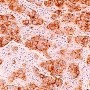 Linfoma de células del manto: Un tipo de cancer infrecuente pero altamente agresivo