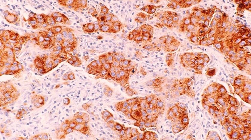 Este cáncer proviene de las células inmunitarias llamadas linfocitos B(UNSPLASH)