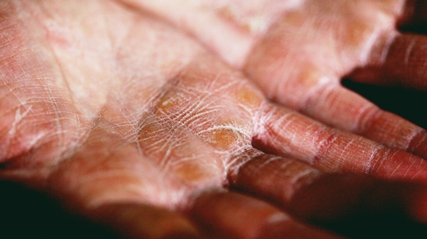 Las afecciones en la piel debido al cambio de estación(PEXELS)