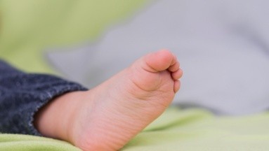 Síndrome del torniquete: Un bebé de 5 meses casi pierde un dedo del pie por un cabello