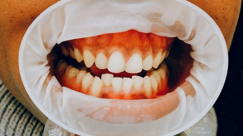 Los dientes turcos se han vuelto una tendencia(PEXELS)