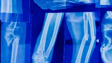 Joven se fractura la pierna derecha en un accidente y por error le operan la izquierda