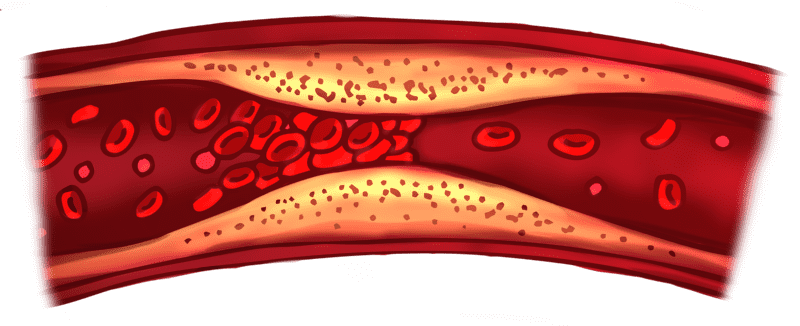 Un coágulo de sangre es una masa que se forma cuando las plaquetas, proteínas y células de la sangre se pegan entre sí. Pexels.