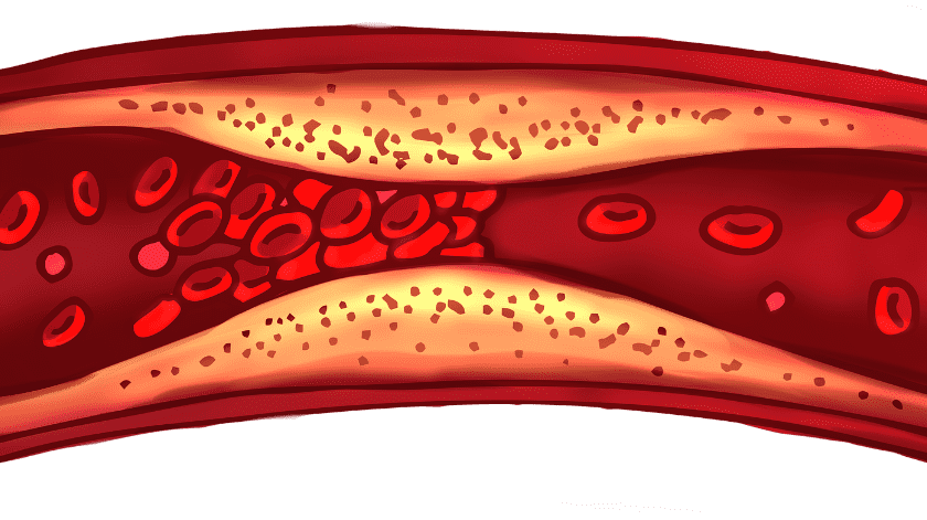 Un coágulo de sangre es una masa que se forma cuando las plaquetas, proteínas y células de la sangre se pegan entre sí(PEXELS)