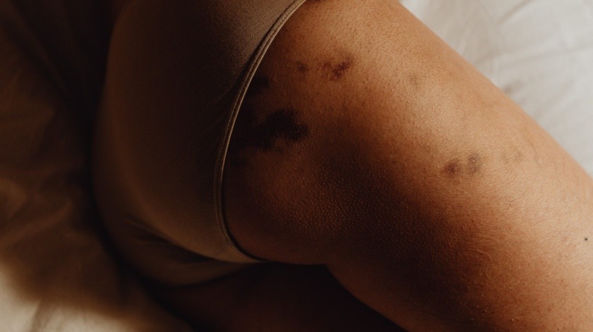 Las mujeres son más propensas a sufrir lesiones durante el sexo.