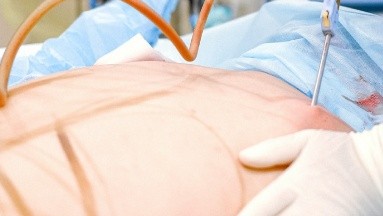 Muere paciente luego de realizarse una cirugía estética en los glúteos en EU