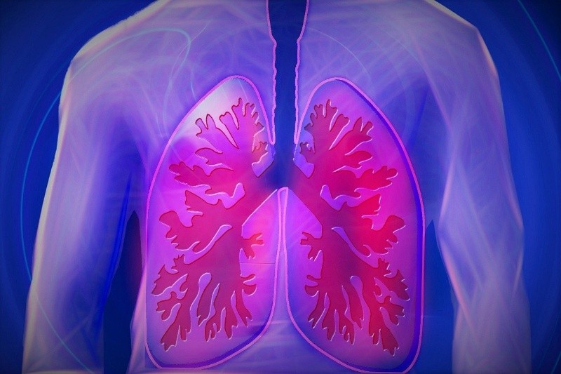 La neumonía puede ser causada por muchos gérmenes, bacterias o virus que infectan el interior de los pulmones  