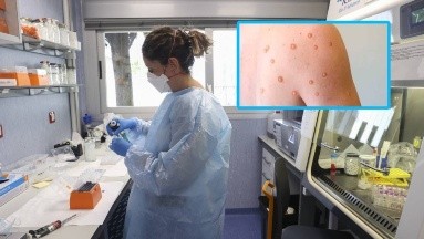 Es aprobado método PCR para diagnosticar la viruela del mono en Perú