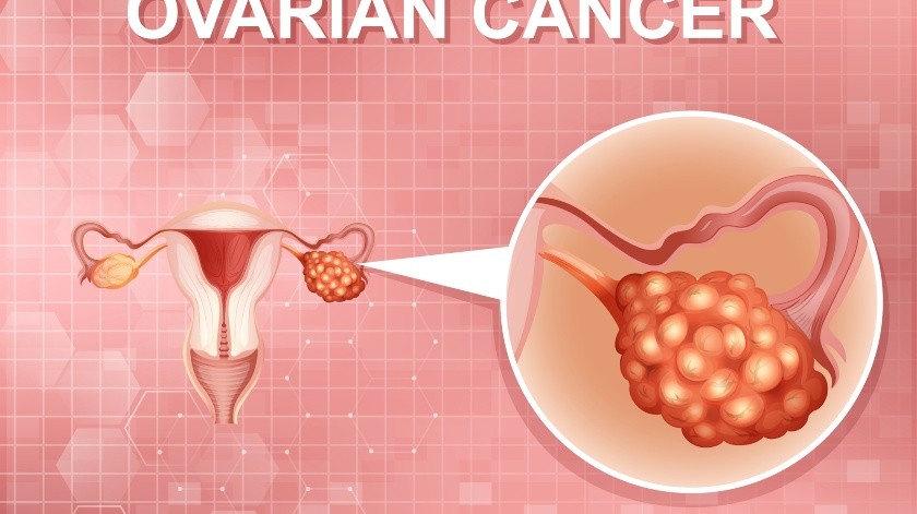 Cuando el cáncer de ovario se detecta a tiempo, hay más probabilidades de tener resultados positivos con el tratamiento.(Freepik)