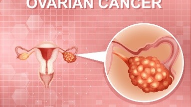 Cáncer ovario: Expertos de EU sugieren extirpar trompas de Falopio para prevenirlo