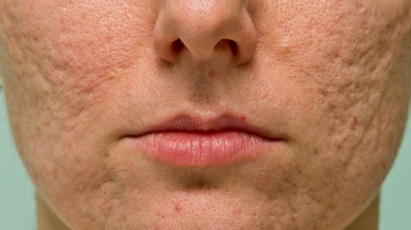 Las cicatrices por el acné pueden disimular mejor.