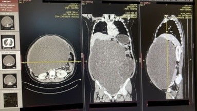 Extirpan un tumor de 20 kilos a una joven 18 años en Perú; le cubría todo el abdomen
