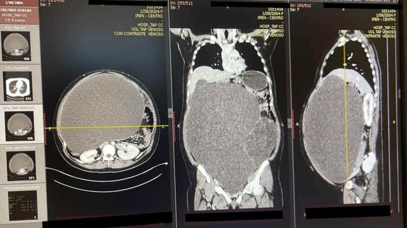 La joven de 18 años tenía un tumor de tamaño similar a un embarazo gemelar.(Minsa Perú)