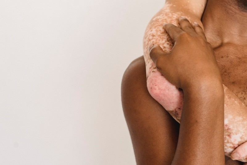 La resequedad en la piel  también puede aparecer por algunas complicaciones de salud como dermatitis. Archivo GH.