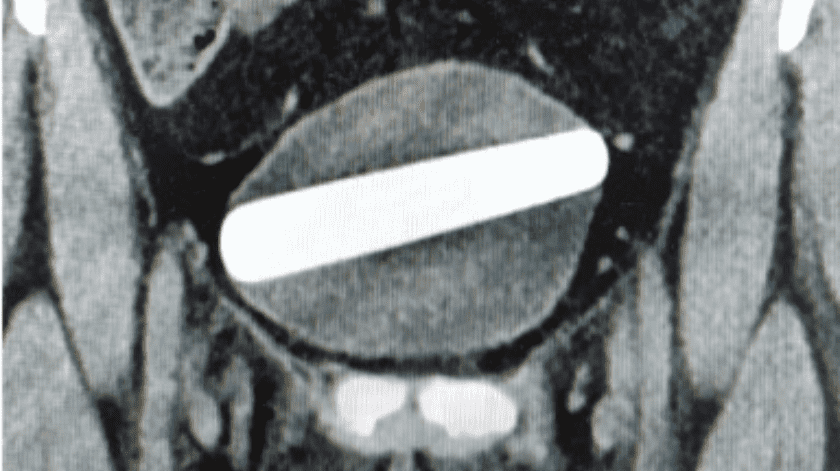 Una ecografía mostró que el consolador estaba atorado, horizontalmente, en su vejiga.(Urology Case Reports)