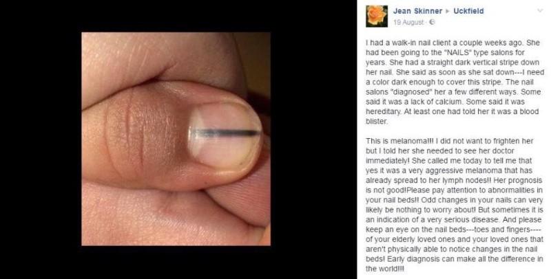  Una manicurista alertó sobre una señal en las uñas que puede indicar melanoma. Foto: Facebook